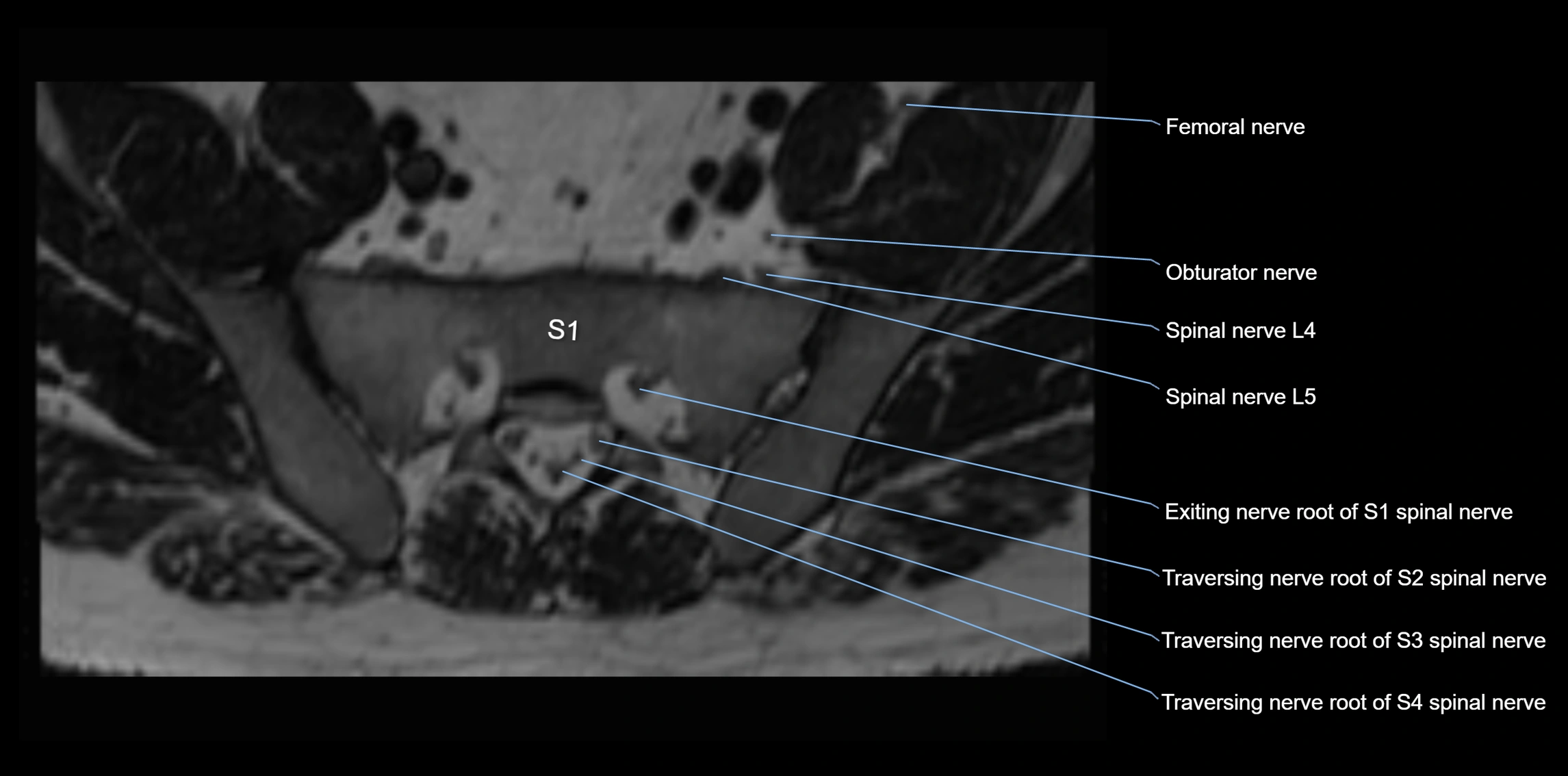 MR lumbosacral plexus axial cross sectional anatomy 3T  radiology  image-img-1008001-00076.webp